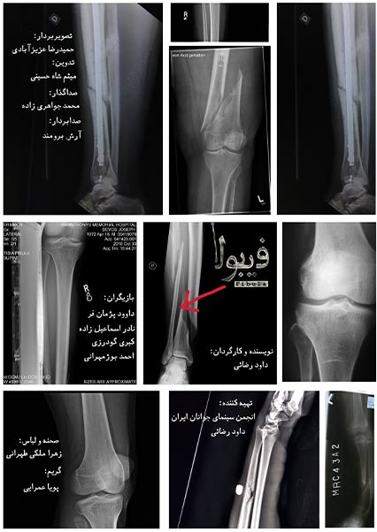 فیبولا